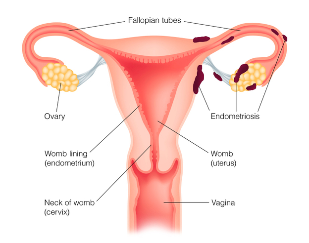 rsz_endometriosis.jpg