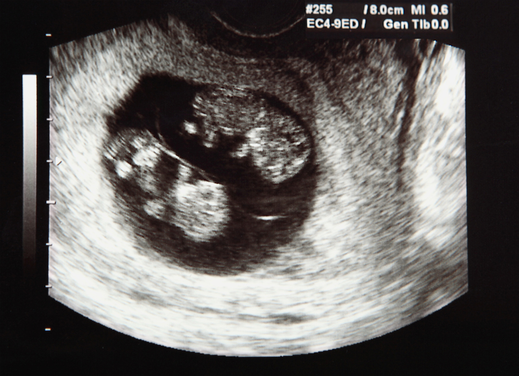 Baby Ultrasound Identical Twins