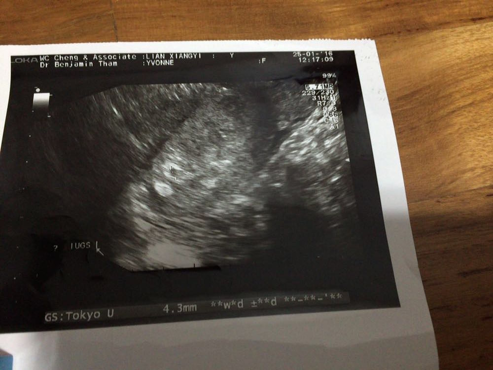 Yvonne ultrasound scan