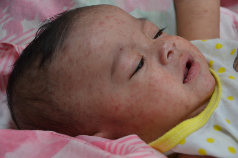 Singapore vaccinations - measles