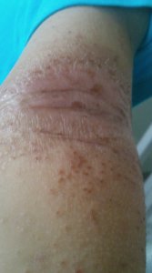 eczema on arm when seeing tcm.jpg