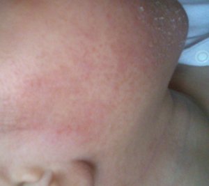 eczema on face.jpg