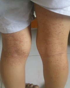 eczema on legs.jpg