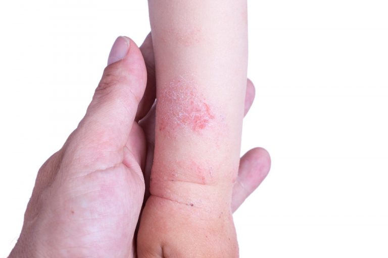 eczema in babies - hand