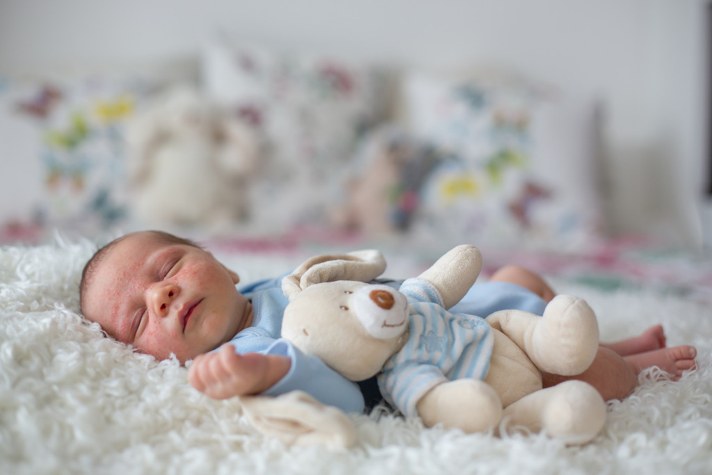 eczema in babies - sleep