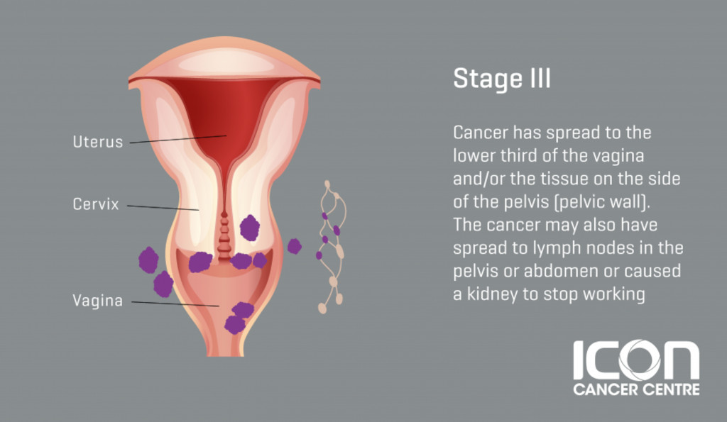 Stage-3-Cervical-Cancer-infographic.jpg